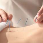 acupuncturist ny